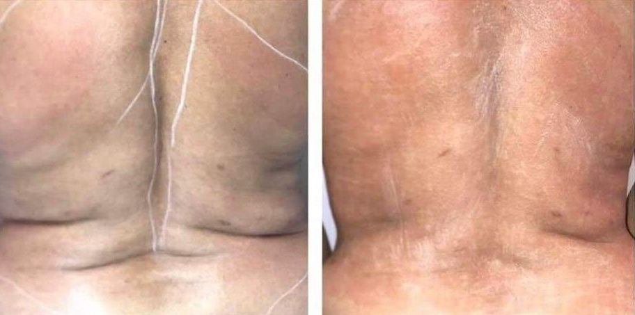 Two views of a person's back showing skin discoloration and lines and cellulite before and cellulite reduction after body countoring and body scultping with a Morpheus8 microneedling with radiofrequency procedure performed by the best cosmetic doctor in Miami, Fl, Dr. Barrueta, at the best med spa in Miami, FL, Monaco MedSpa.