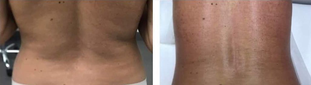 Two back views of a person, before and after a treatment, with fat loss after body countoring and body scultping with a Morpheus8 microneedling with radiofrequency procedure performed by the best cosmetic doctor in Miami, Fl, Dr. Barrueta, at the best med spa in Miami, FL, Monaco MedSpa..