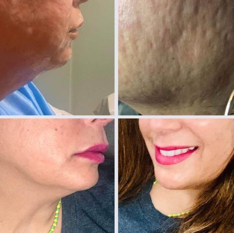 Morpheus 8 Face Treatment, Morpheus 8Neck Treatment, Jaw Contouring, Cheek Contouring Filler,  photo of Before and After morpheus8 acne treatments, Monaco Medspa in Midtown Edgewater Miami, FL, morpheus8 for acne, Morpheus8 acne Resurfacing Monaco med spa in downtown worldcenter edgewater midtown Miami, FL
