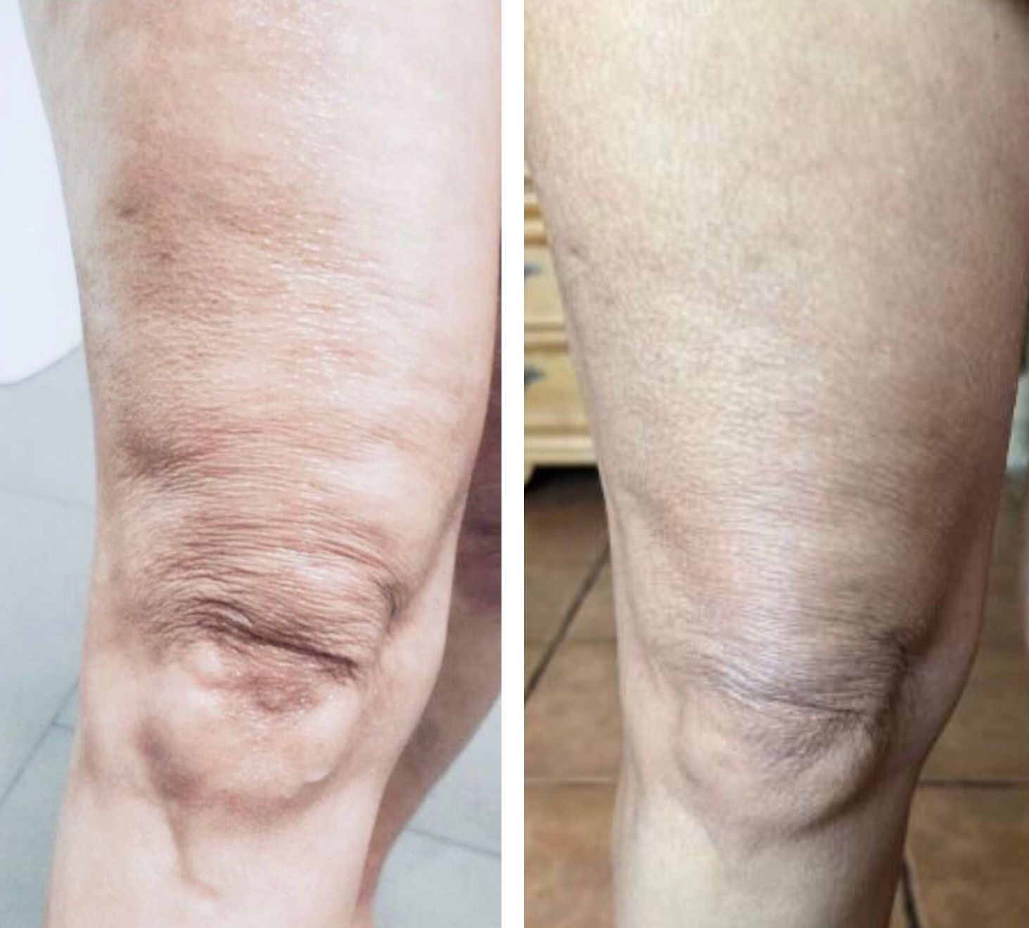 Two images of a knee, showing before and after skin lightening treatment, with a noticeable color difference after body countoring, cellulite treatment, cellulite reduction, and body scultping with a Morpheus8 microneedling with radiofrequency procedure performed by the best cosmetic doctor in Miami, Fl, Dr. Barrueta, at the best med spa in Miami, FL, Monaco MedSpa.