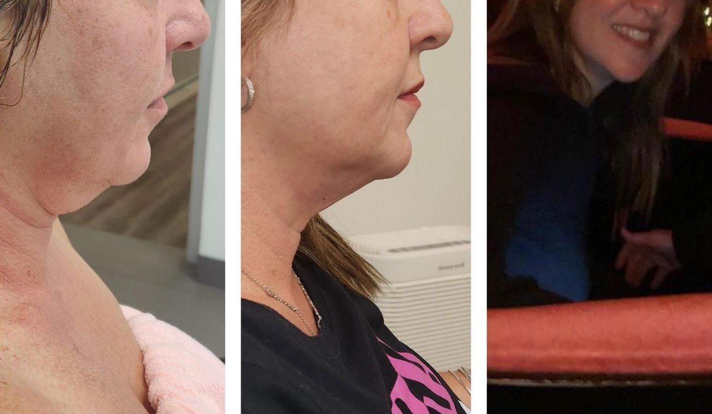 microneedling with radiofrequency, Before and After, Monaco Medspa in Midtown Edgewater Miami, FL, Morpheus8 Face, Morpheus8 Eyelids, Morpheus8 Neck, Photos of Before and After Morpheus8, Monaco med spa in Midtown Edgewater Miami, FL