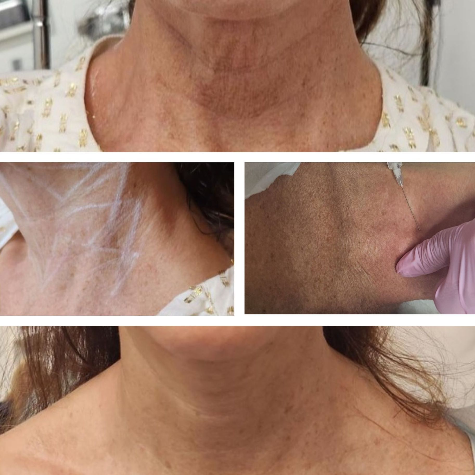 Monaco MedSpa, Miami, FL, Before and After, Midtown miami, Edgewater Miami, FL, Top Row: Before Any Treatments.
Middle Row Left Photo: Neck Marked Prior To Procedure.
Middle Row Right Photo: Injecting Neck With A Biostimulating Filler.
Bottom Row: Final Result After 1 Morpheus8 Neck Treatment & 2 Biostimulating Neck Filler Procedures. radiesse, photo of Before and After of a nonsurgical neck lift cosmetic neck treatment at Monaco med spa Midtown Miami, Edgewater Miami, FL, and Morpheus8 Face & Neck Treatments, . nonsurgical necklift, neck lift, neck restoration treatments