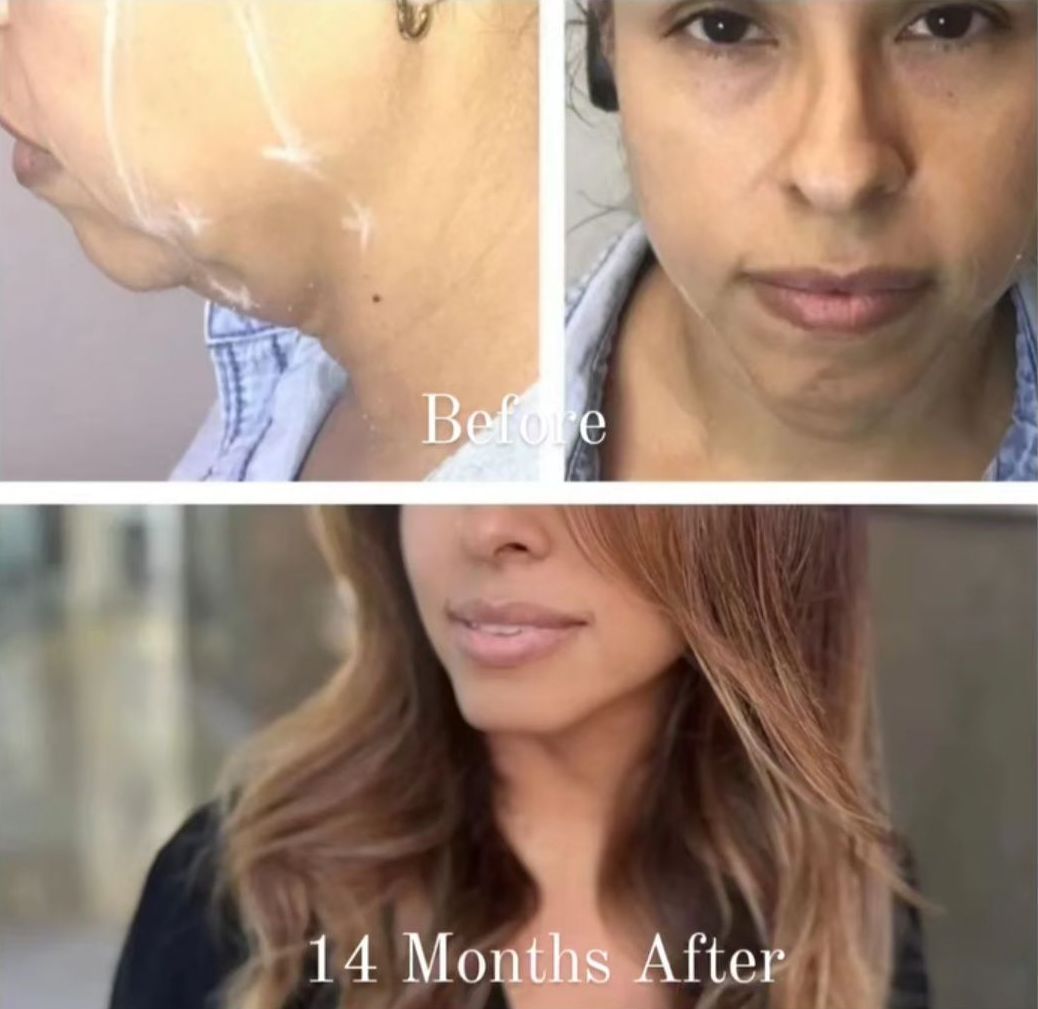 Monaco Med Spa, Miami, FL, Before and After, Midtown miami, Edgewater Miami, FL, PDO Thread Lift, Before PDO Thread Nonsurgical Jowl & Neck Lift, Monaco med spa in downtown worldcenter edgewater midtown Miami, FL, photo of Before and After pdo thread nonsurgical facelift, face lift. neck lift, and neck lift Midtown Miami, FL
