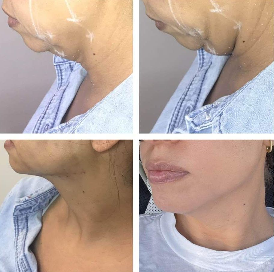 Monaco Med Spa, Miami, FL, photo of pdo thread Before and After of nonsurgical facelift, face lift. neck lift, and neck lift Midtown Miami, Edgewater Miami, FL, PDO Thread Lift, pdo threadlift, Before PDO Thread Nonsurgical Jowl & Neck Lift, Monaco med spa in downtown worldcenter edgewater midtown Miami, FL