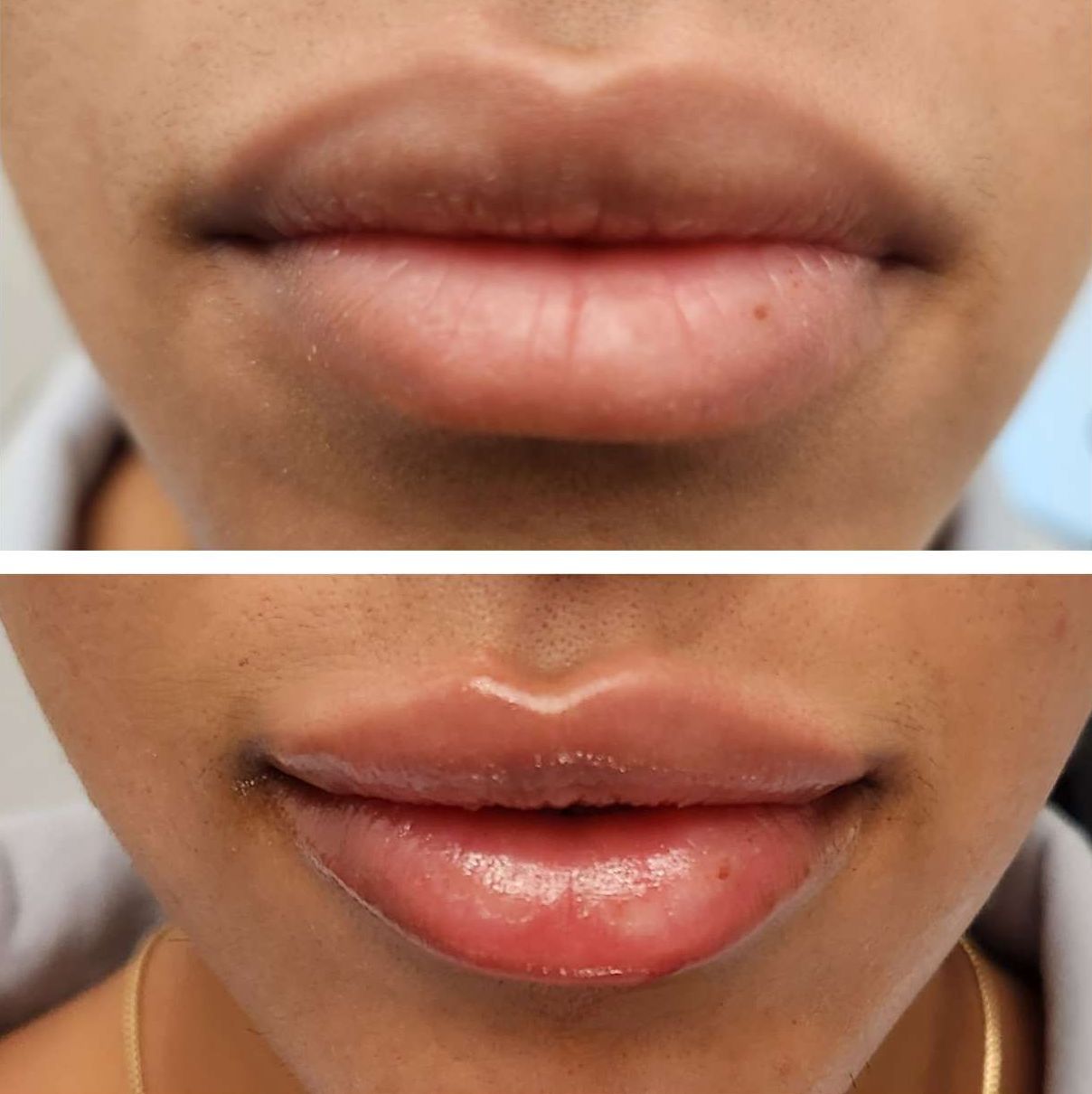 Before and after photo of lips. Top: thin, dark lips. Bottom: fuller, pink lips with lip filler after lip filler injections perfomed by the best lip filler injector and cosmetic doctor in Miami, Fl, Dr. Barrueta, at the best med spa in Edgewater Miami, FL, Monaco MedSpa..