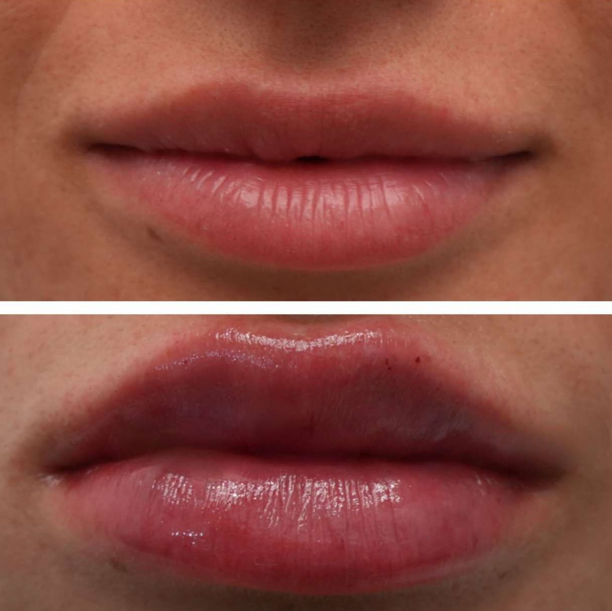 Top: thin lips. Bottom: plump, full lips, after lip filler injections perfomed by the best lip filler injector and cosmetic doctor in Miami, Fl, Dr. Barrueta, at the best med spa in Miami Beach Miami, FL, Monaco MedSpa.