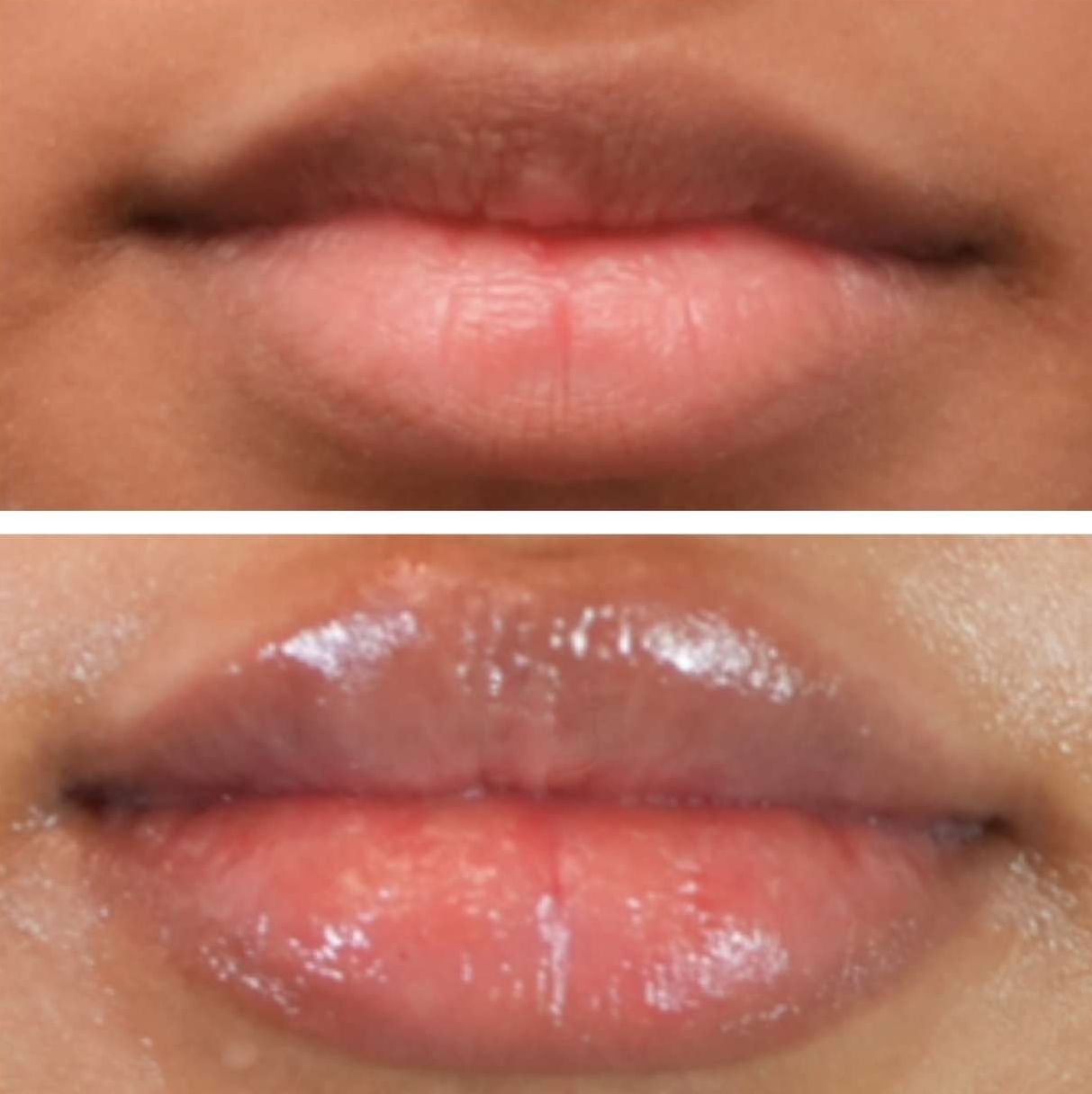 Top: Un-glossed thin lips; bottom: glossy, beautiful lips after lip filler injections perfomed by the best lip filler injector and cosmetic doctor in Miami, Fl, Dr. Barrueta, at the best med spa in Star Island Miami, FL, Monaco MedSpa.
