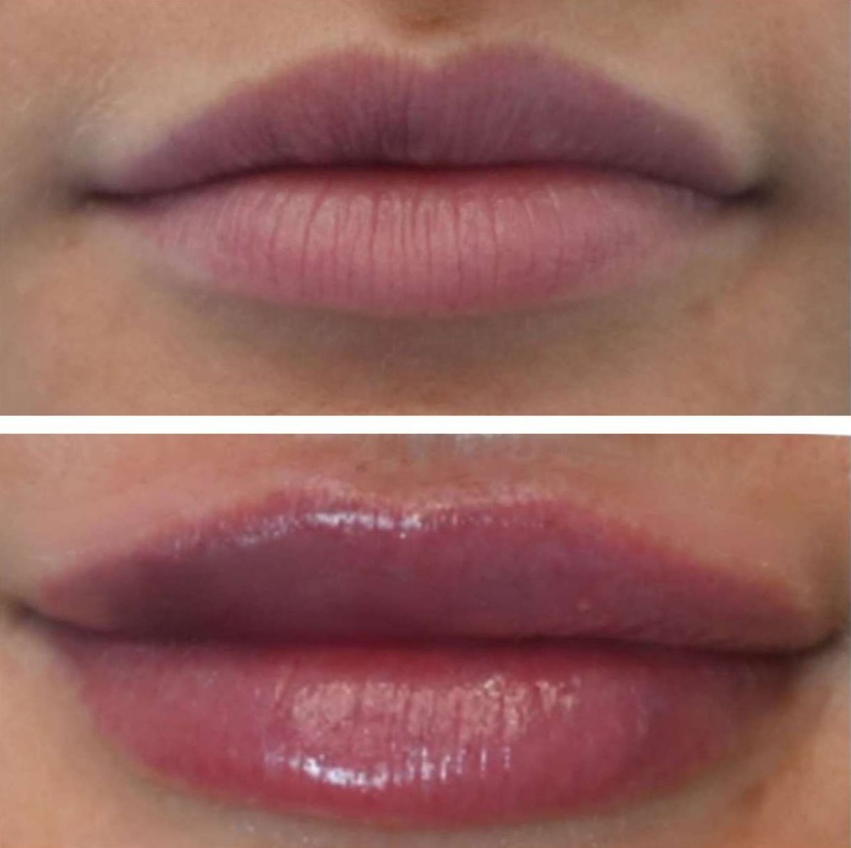 Top: Close-up of un-glossed lips. Bottom: Close-up of lips with gloss. Lips appear fuller after lip filler injections perfomed by the best lip filler injector and cosmetic doctor in Miami, Fl, Dr. Barrueta, at the best med spa in Midtown Miami, FL, Monaco MedSpa.