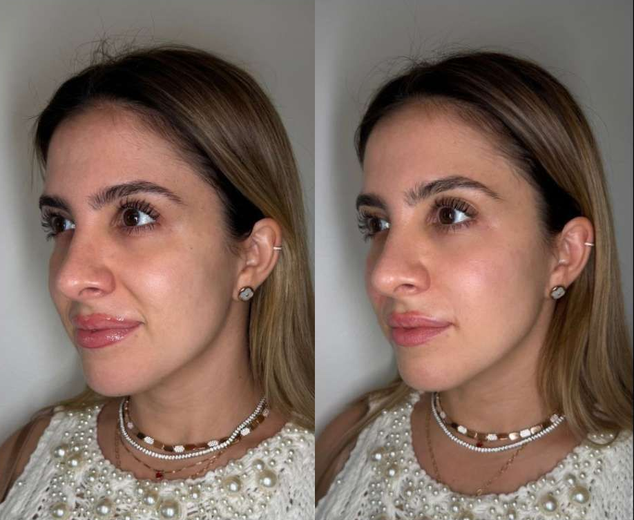Photo of a client Before and Immediately After Nasolabial and Zygoma Filler performed by the best cosmetic doctor in Miami, FL at the best med spa in Miami, Monaco MedSpa