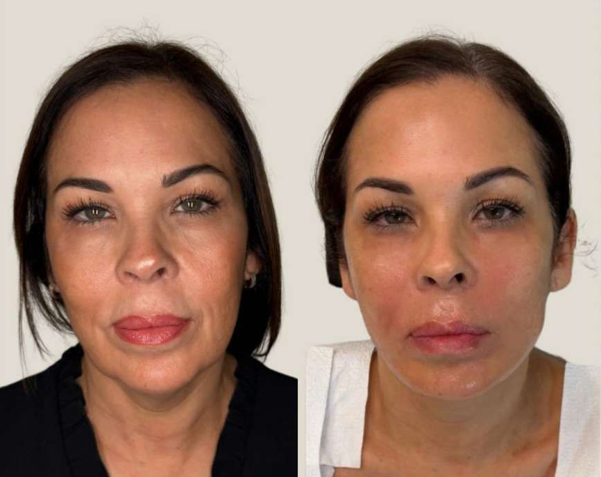Image of a female face
Before and 3 Months After Hyaluronic Acid HA Fillers including Jaw Contouring Filler, Cheek Filler, Chin Filler and Periauricular Biostimulating Filler by Dr. Barrueta the best cosmetic doctor injector in Miami, FL at the best med spa in Miami, Monaco MedSpa