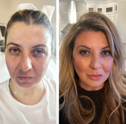 Facial Harmonization
Morpheus8 Face, Eyelids & Neck
Before & 3 Weeks After
Botox Eyebrow Lift
& Lower Lip Filler
One Treatment Session
Bottom Lip Filler & Botox Eyebrow Lift, Monaco MedSpa, Miami, FL, photo of nonsurgical facelift with Morpheus8 Before and After, in Midtown miami, Edgewater Miami, FL, microneedling with radiofrequency, at Monaco med spa in downtown worldcenter edgewater midtown Miami, FL
