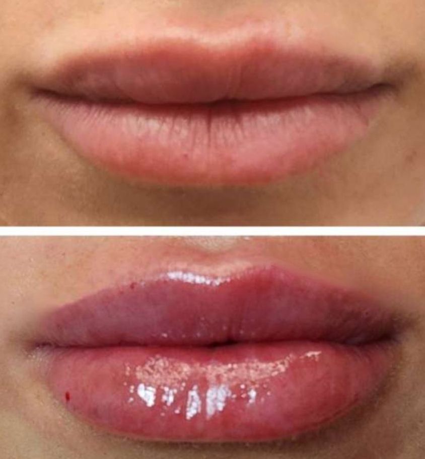Photos of Lip Filler, Before and Immediatelty After ip filler showing the most beuatiful lips in Miami, Fl injected with lip filler by the best cosmetic doctor in Miami, FL, Dr. Jeannette Barrueta, at the best med spa in Miami, FL, Monaco MedSpa, near Midtown, Edgewater and Brickell