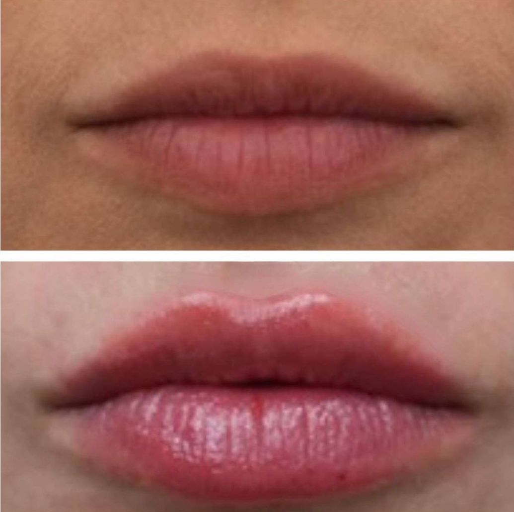 Comparison of lips: top is thinner, bottom is fuller and glossier after lip filler injections perfomed by the best lip filler injector and cosmetic doctor in Miami, Fl, Dr. Barrueta, at the best med spa in Fisher Island Miami, FL, Monaco MedSpa.