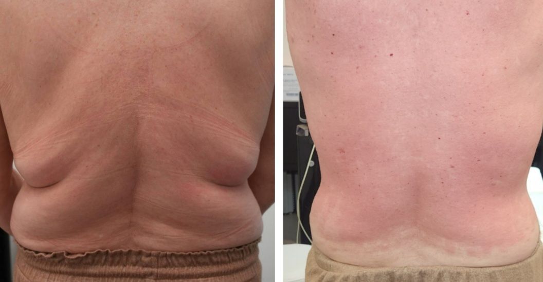 Back of a person before and after fat reduction treatment. Skin appears smoother and less bulging after body countoring and body scultping with a Morpheus8 microneedling with radiofrequency procedure performed by the best cosmetic doctor in Miami, Fl, Dr. Barrueta, at the best med spa in Miami, FL, Monaco MedSpa...