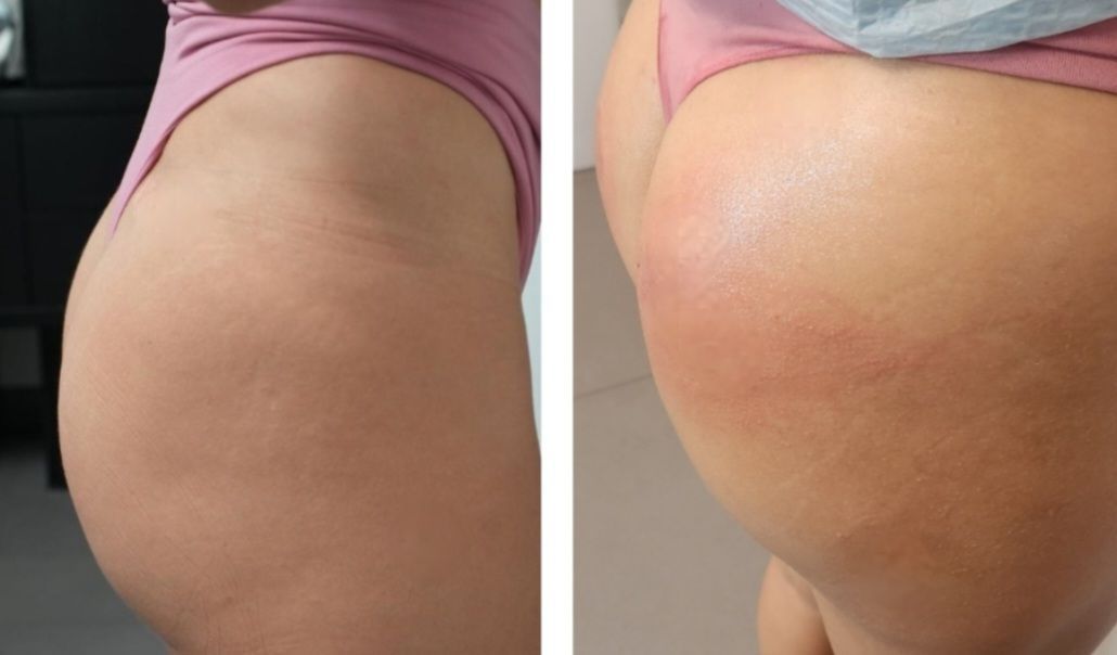Before and after photo of Sculptra buttock butt lift, a nonsurgical buttock butt lift done at Monaco med spa in Edgewater Midtown Downtown Brickell and Miami, FL