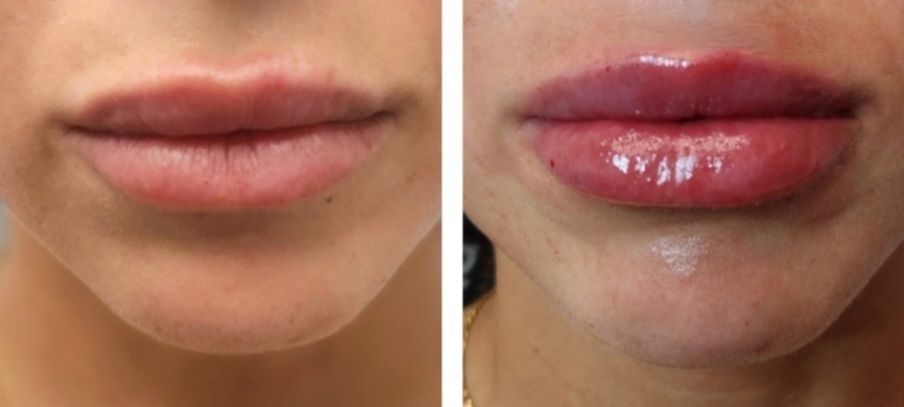 Before and after photos of lips, showing lip enhancement via cosmetic procedure after lip filler injections perfomed by the best lip filler injector and cosmetic doctor in Miami, Fl, Dr. Barrueta, at the best med spa in Sunny Isles, Midtown Miami, Downtown Miami, and Brickell Miami, FL, Monaco MedSpa.