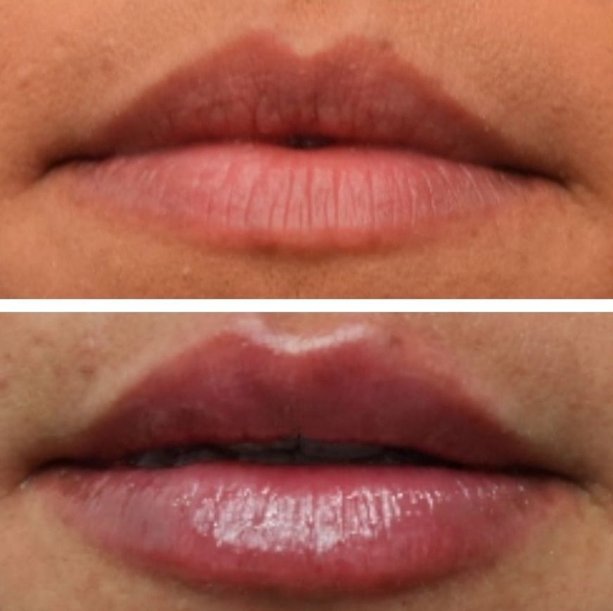 Two sets of lips, top one natural, bottom one fuller and pink after lip filler injections perfomed by the best lip filler injector and cosmetic doctor in Miami, Fl, Dr. Barrueta, at the best med spa in Coral Gables Miami, FL, Monaco MedSpa..