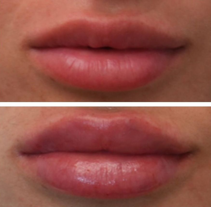 Photo of Lip Filler, Before and Immediatelty After, Monaco MedSpa, in Midtown Edgewater Miami, FL,