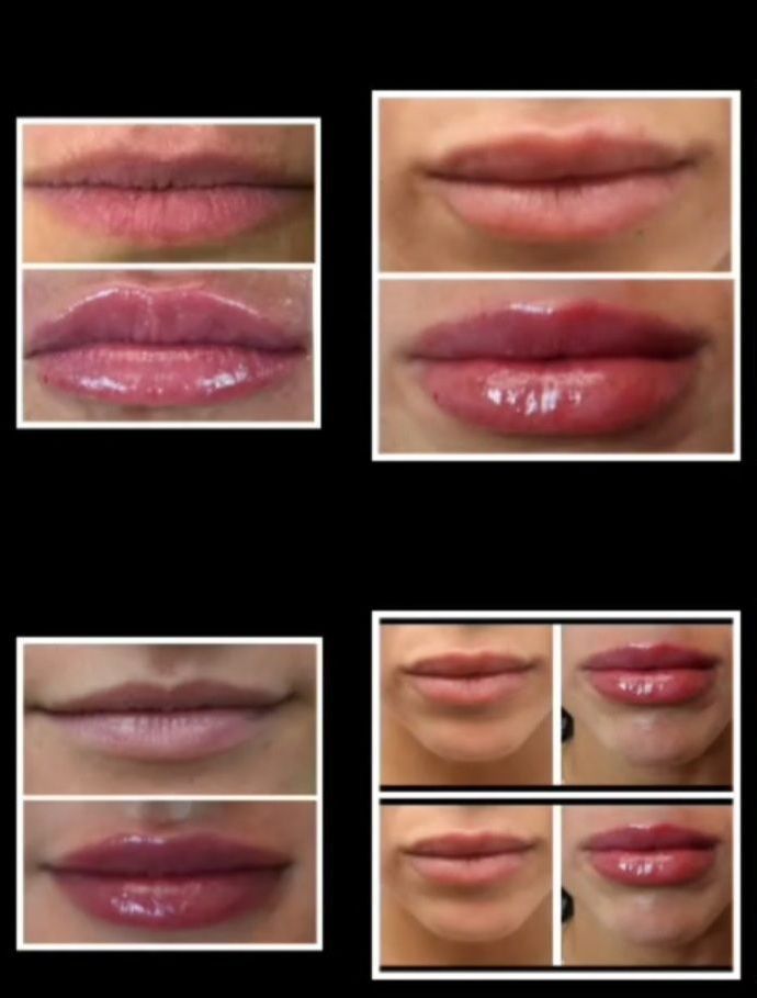 Image of beofre and after lip filler by dr. barrueta of Monaco MedSpa, Miami, FL.