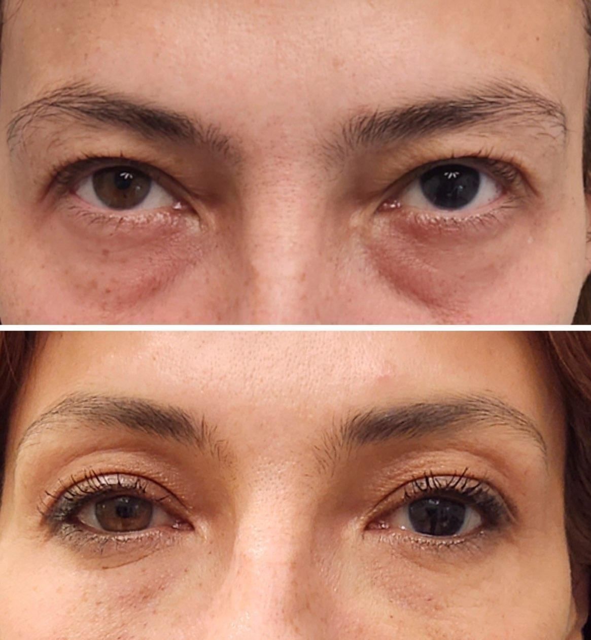 Before and After, Monaco Medspa in Midtown Edgewater Miami, FL, Tear Trough filler, Undereye Filler, lower eyelid filler, Morpheus8 Eyelids, Photo of Before and After tear trough filler Hyaluronic Acid Filler, Monaco med spa in Midtown Edgewater Miami, FL