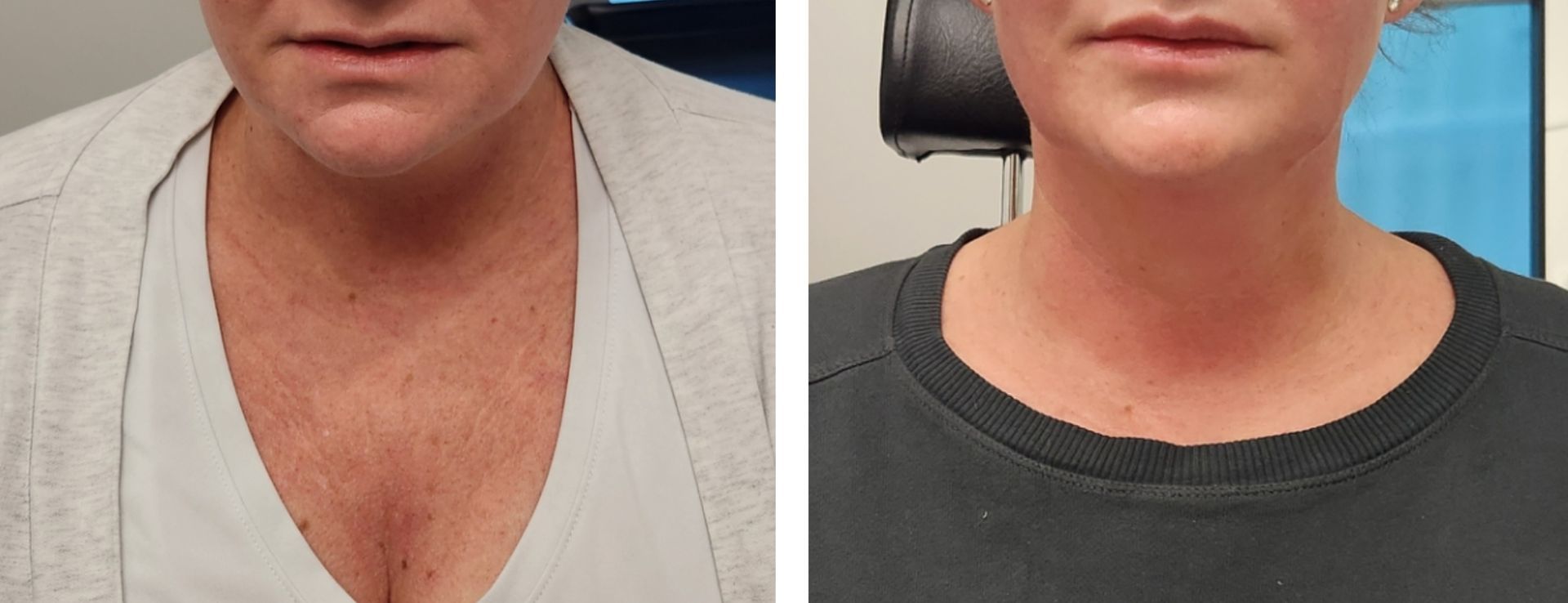 A before and after photo of a woman 's neck and chest.