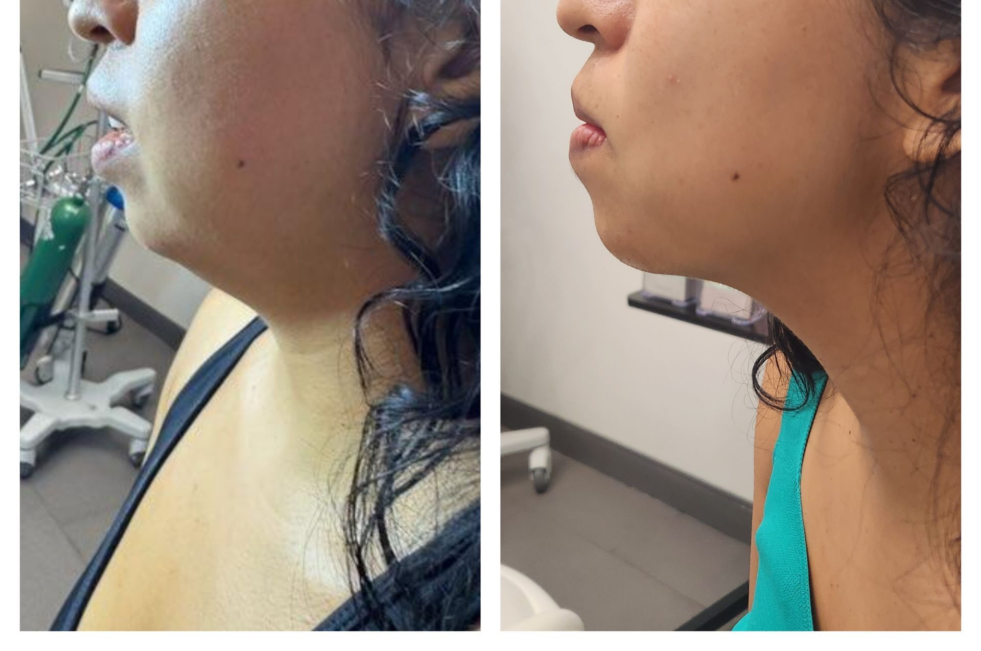A before and after photo of a woman 's neck and face. 