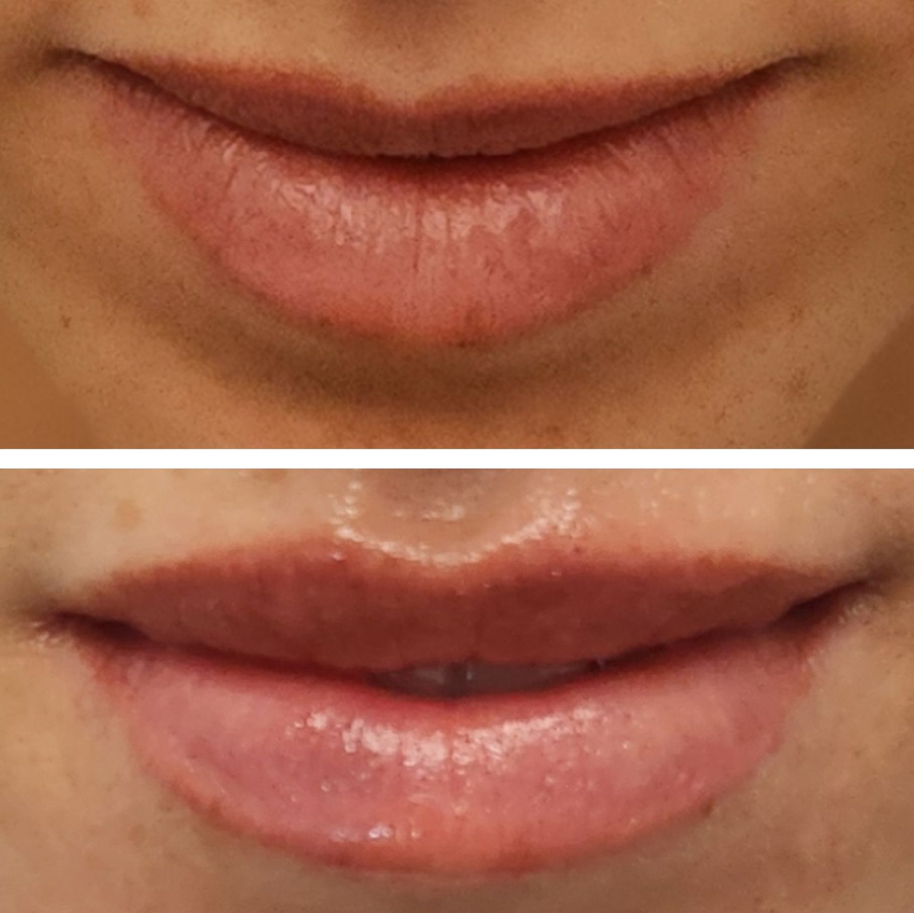 Top: thin, natural lips. Bottom: plumper beautiful lips after lip filler injections perfomed by the best lip filler injector and cosmetic doctor in Miami, Fl, Dr. Barrueta, at the best med spa in Pinecrest Miami, FL, Monaco MedSpa.