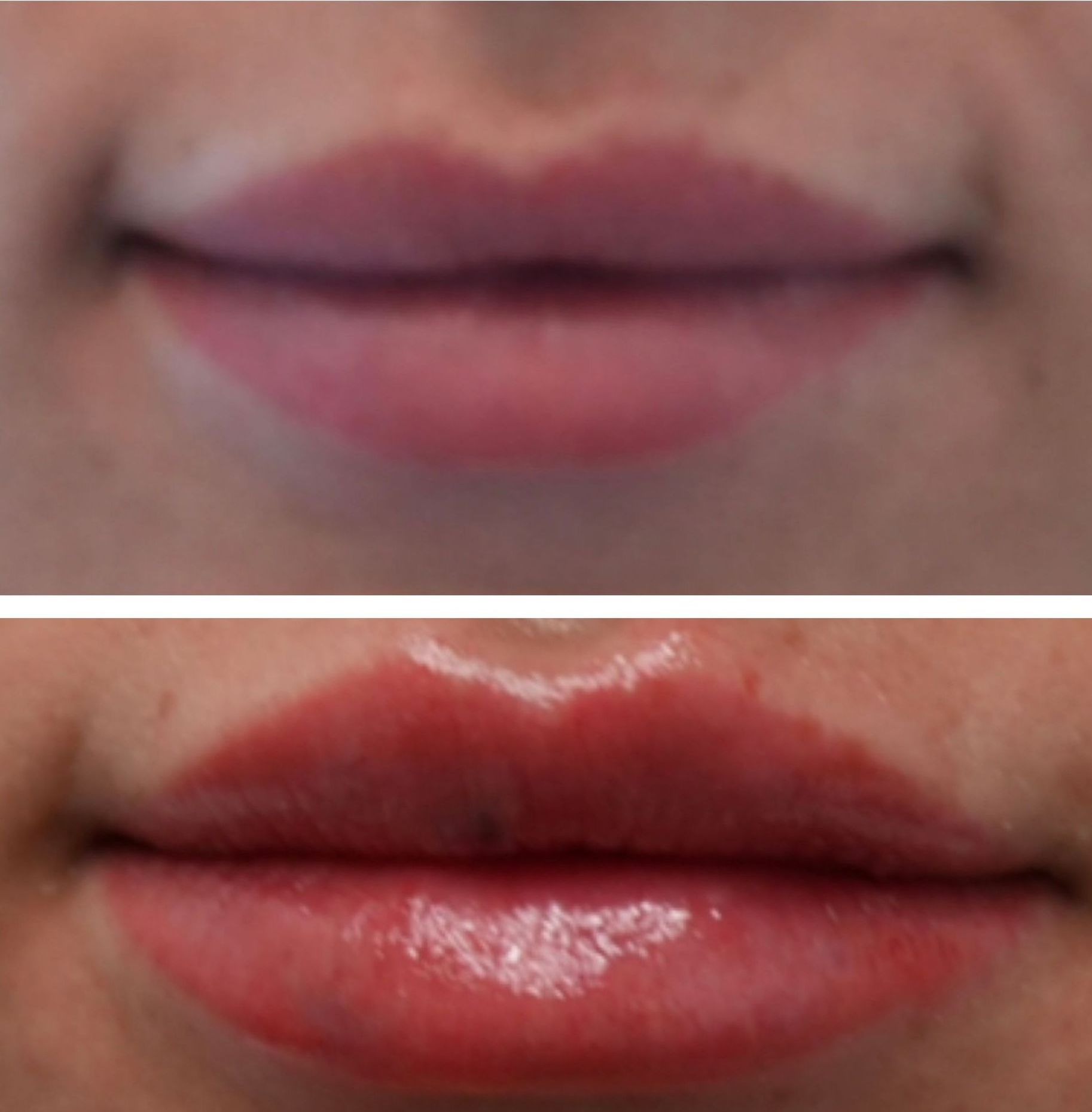 Photo of Before and After Lip Filler at Monaco med spa in Midtown Edgewater Miami, FL