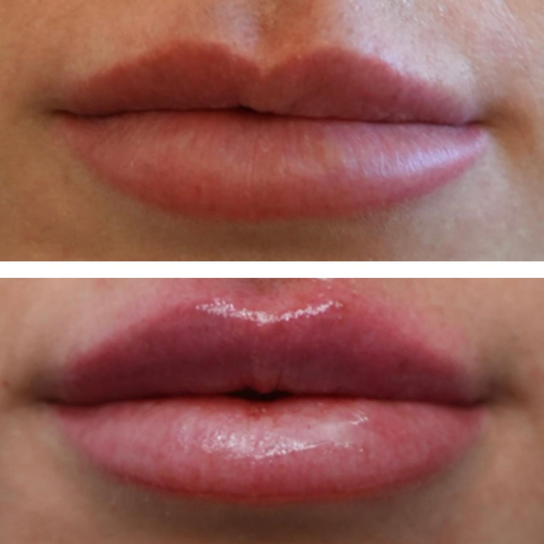 Photo of Lip Filler, Before and Immediatelty After, performed by the best cosmetic surgeon in Miami Dr. Barrueta at the best med spa in Miami, Monaco MedSpa, in Midtown Edgewater Miami, FL
