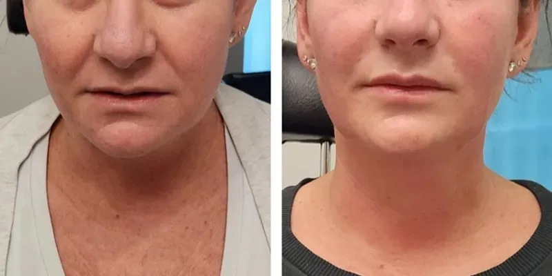 botulinum toxin, dysport, botox, Before and After, Monaco Medspa in Midtown Edgewater Miami, FL, trapezius botox, barbie botox, shoulder slimming botox, Nose botox, nasal slimming botox, nose tip botox, Undereye botox, microbotox, lower eyelid botox, lower eyelid microbotox, marionette line botox, DAO botox, Chin botox, lower face botox, Upper Botox Lip Flip botox, lip flip, lip flip botox, Jawline Nefertiti botox, Neck Bands botox, neck bands botox, nefertiti botox, platysmal neck band botox, anterior neck band botox, Photo of Before and After Botox, Filler, Monaco med spa in Midtown Edgewater Miami, FL