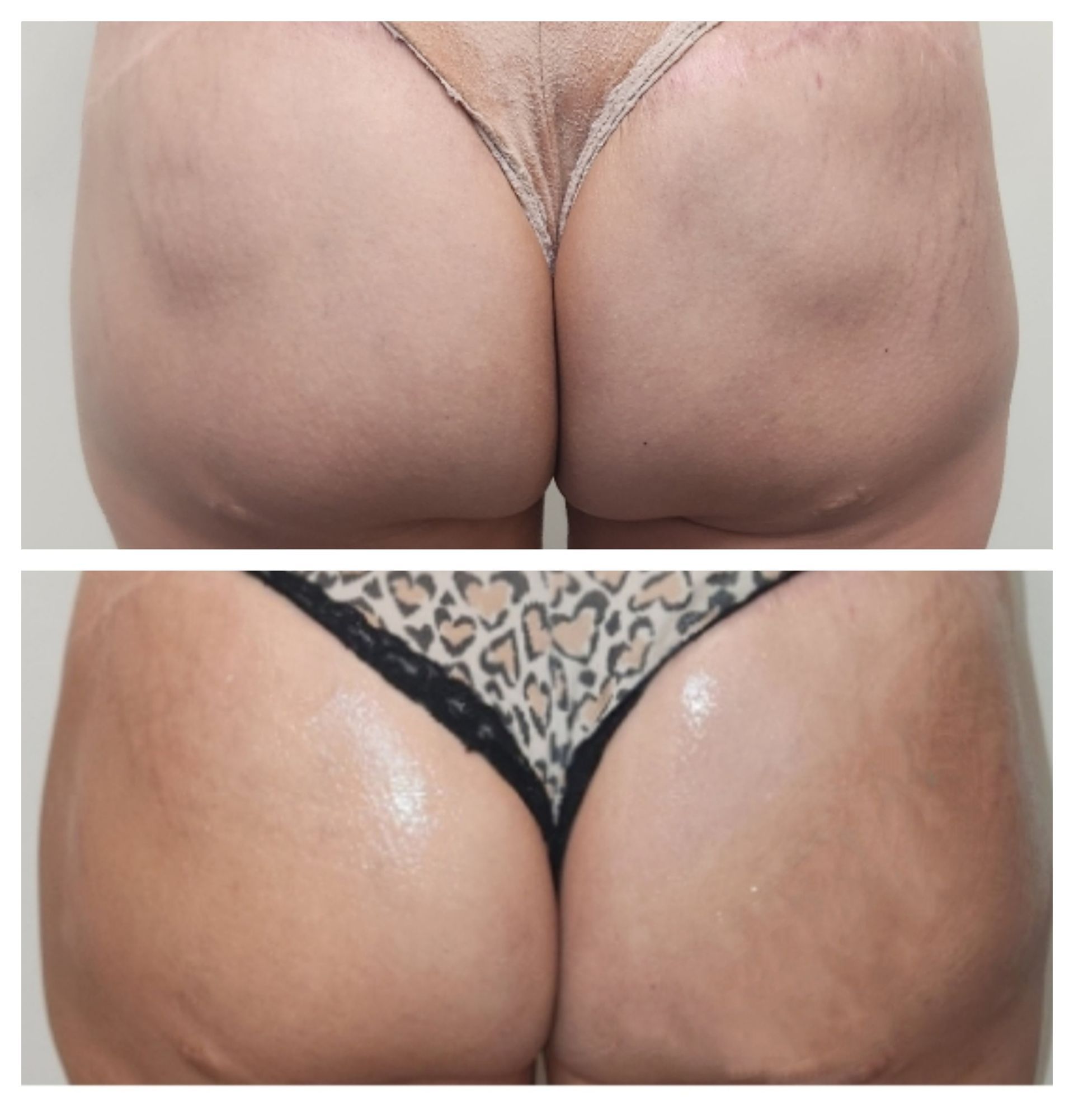 Before & After Sculptra Butt Lift Before & After Sculptra Butt Lift, Monaco MedSpa, Miami, FL.