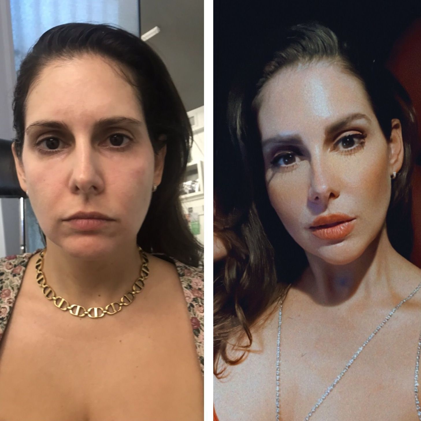 Hyaluronic Acid Filler, Before and 2 Months After All Treatment, Monaco MedSpa, Miami, FL,  Midtown Edgewater Miami, FL, before & after, Before & 2 Months After All Treatments: Morpheus 8 Face & Neck Followed By Jaw Contouring & Cheek Contouring Filler, Lip Filler, Chin Filler & Eyebrow Botox, Photo of Before and After Hyaluronic Acid Filler, Monaco med spa in Midtown Edgewater Miami, FL