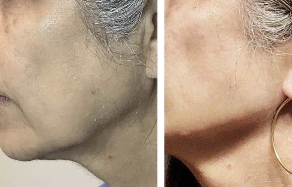 Monaco MedSpa, Miami, FL, edgewater miami, midtown miami, jaw contouring, jaw filler, ha filler, restylane, juvederm, radiesse, before and after, photo of before and after jaw contouring filler at Monaco med spa in downtown worldcenter edgewater midtown Miami, FL