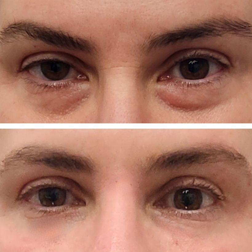 Before & One Week After Lower Eyelid Botox & Immediately After, Before & Immediately After, Monaco MedSpa, Miami, FL, edgewater miami, midtown miami, eyelid filler, tear trough filler, undereye filler, lower eyelid filler, ha filler, hyaluronic acid filler, juvederm, restylane, belotero, Photo of Before and After tear trough filler Hyaluronic Acid Filler, Monaco med spa in Midtown Edgewater Miami, FL
