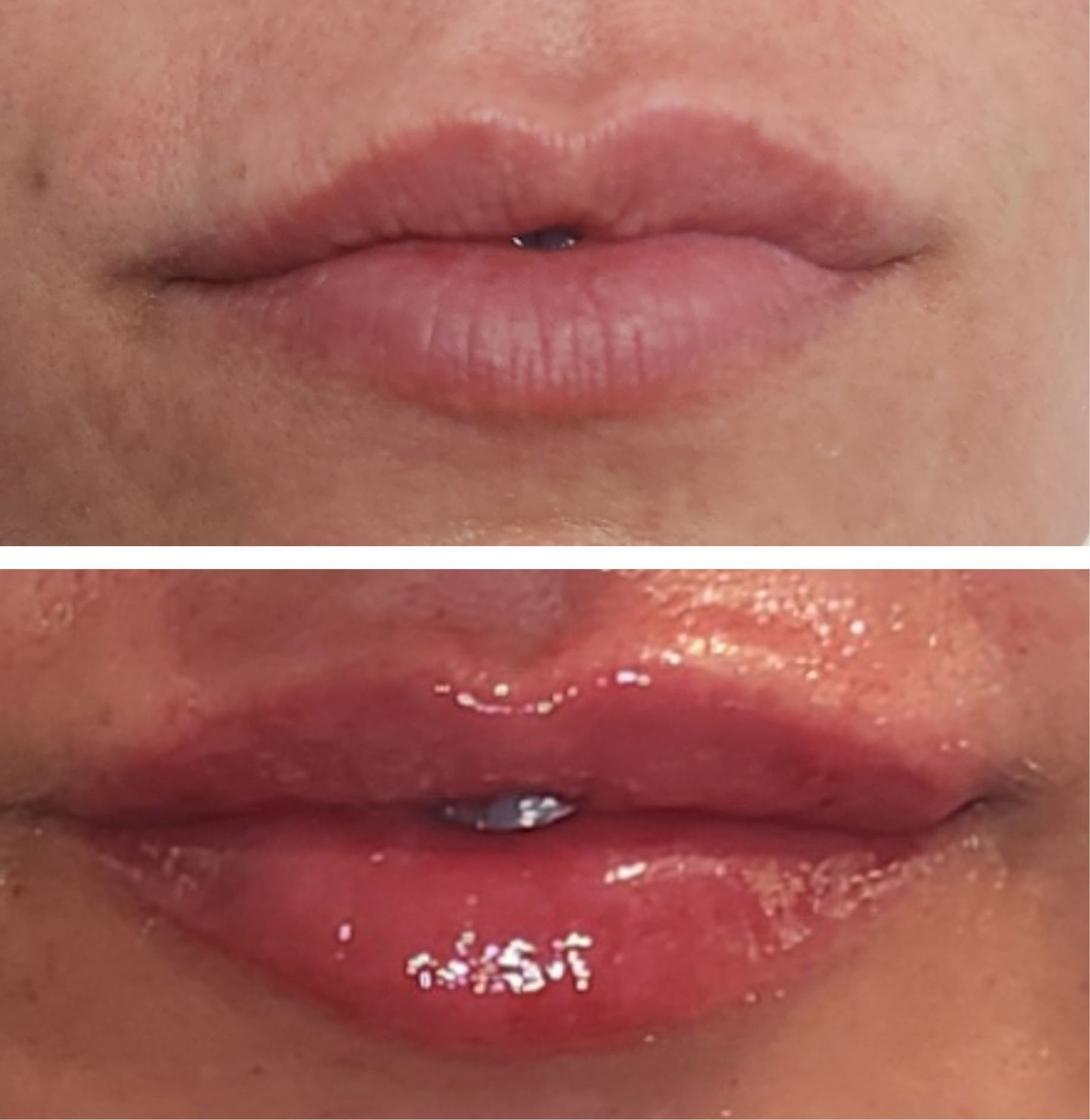 Before and after photo of lips: top, natural lips; bottom, full, glossy lips after lip filler injections perfomed by the best lip filler injector and cosmetic doctor in Miami, Fl, Dr. Barrueta, at the best med spa in Brickell Miami, FL, Monaco MedSpa.