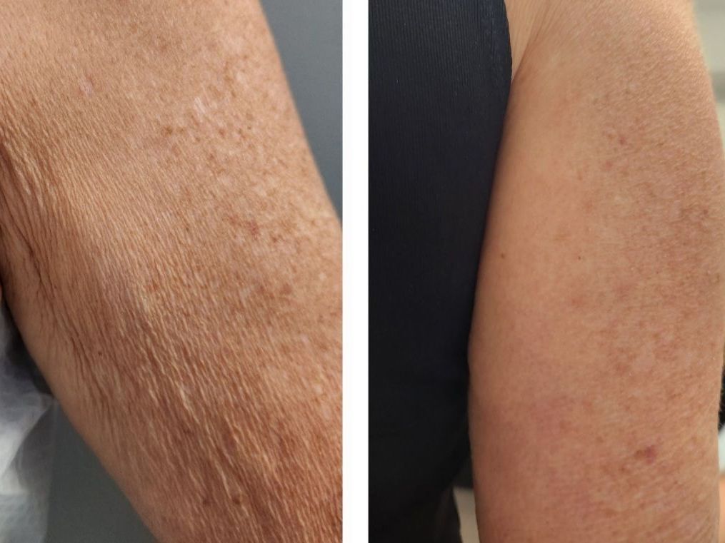 Two images of an arm showing skin texture improvement after treatment; the left shows wrinkles and spots, the right smoother skin after body countoring and body scultping with a Morpheus8 microneedling with radiofrequency procedure performed by the best cosmetic doctor in Miami, Fl, Dr. Barrueta, at the best med spa in Miami, FL, Monaco MedSpa.
