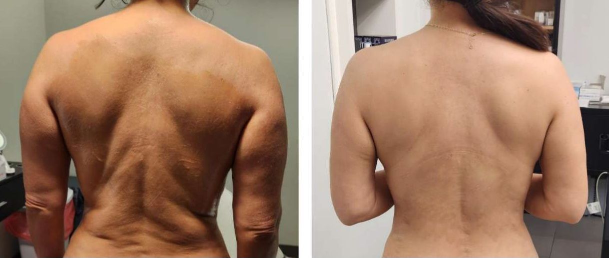 Two photos of a woman's back. Left photo shows excess skin; right shows a smoother back after treatment after body countoring and body scultping with a Morpheus8 microneedling with radiofrequency procedure performed by the best cosmetic doctor in Miami, Fl, Dr. Barrueta, at the best med spa in Miami, FL, Monaco MedSpa..