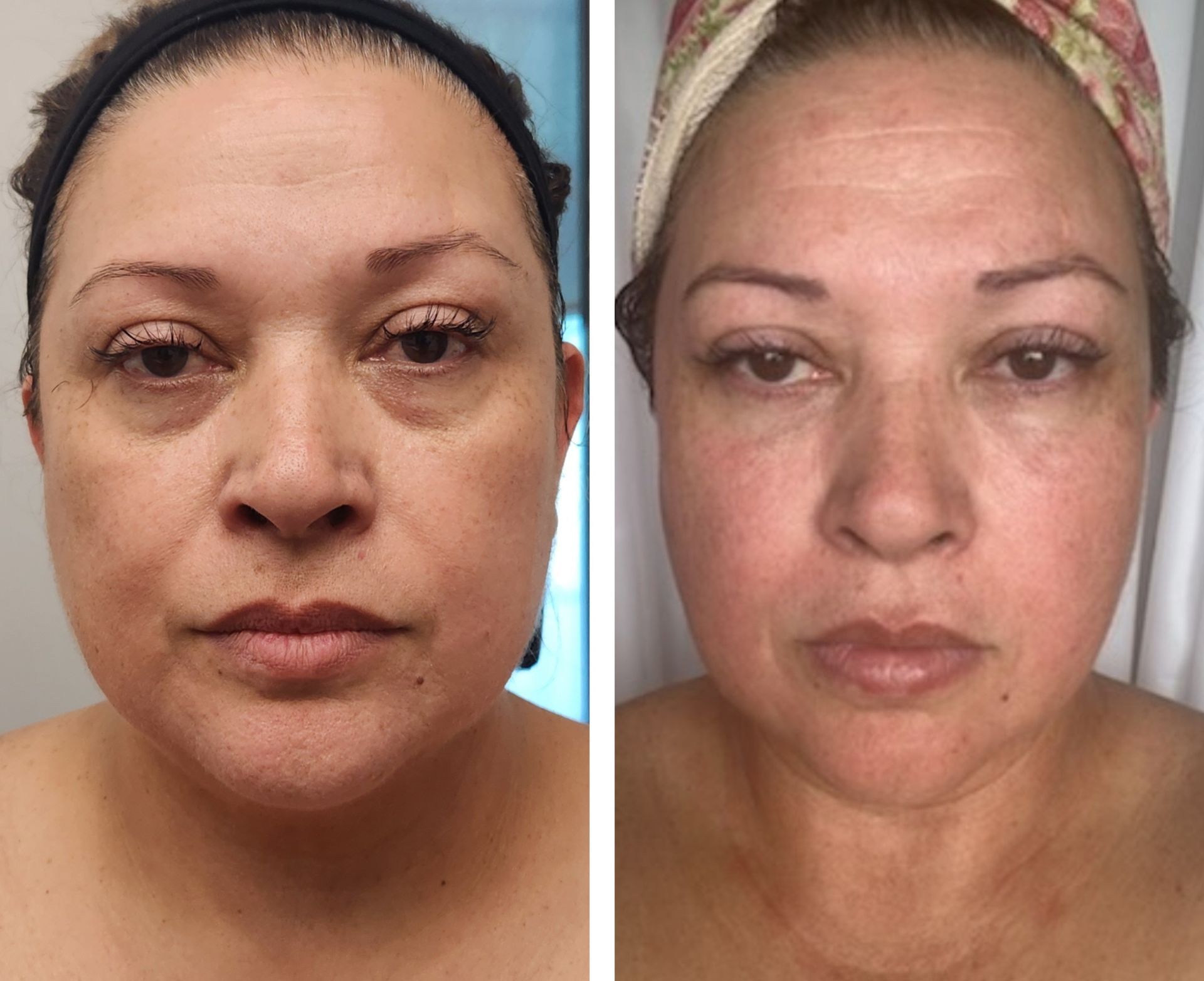 Side-by-side comparison of a woman's face before and after a skincare treatment; reduced wrinkles, brighter complexion.