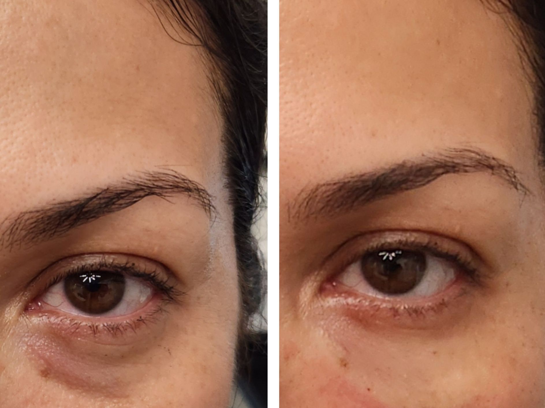 Monaco MedSpa, Miami, FL, tear trough, undereye filler, Before and After, Monaco Medspa in Midtown Edgewater Miami, FL, Photo of Before and After tear trough filler Hyaluronic Acid Filler, Monaco med spa in Midtown Edgewater Miami, FL