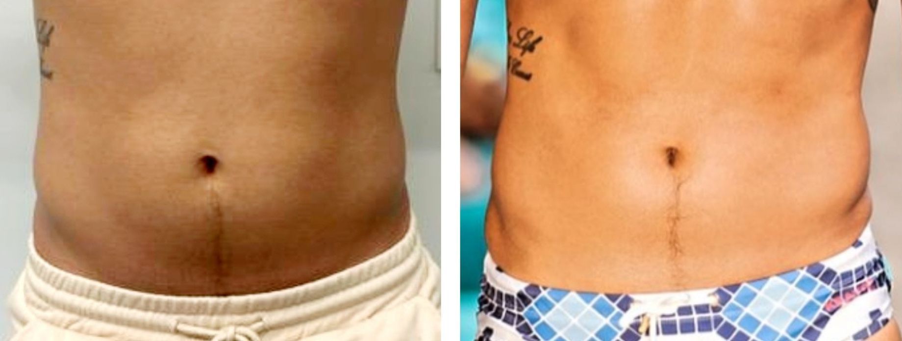 A before-and-after view of a person's stomach; the after shows a slimmer and skinnier abdomen after body countoring and body scultping with a Morpheus8 microneedling with radiofrequency procedure performed by the best cosmetic doctor in Miami, Fl, Dr. Barrueta, at the best med spa in Miami, FL, Monaco MedSpa.
