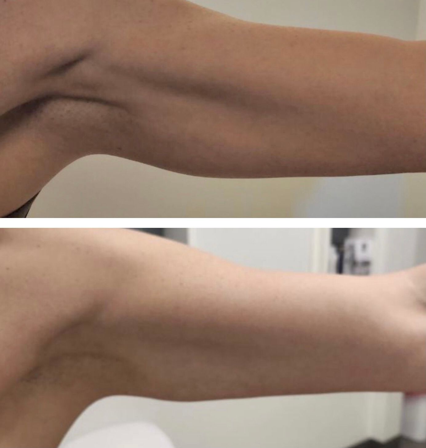 Before and after photos of an arm; skin appears smoother, tighter in the after photo after body countoring and body scultping with a Morpheus8 microneedling with radiofrequency procedure performed by the best cosmetic doctor in Miami, Fl, Dr. Barrueta, at the best med spa in Miami, FL, Monaco MedSpa.