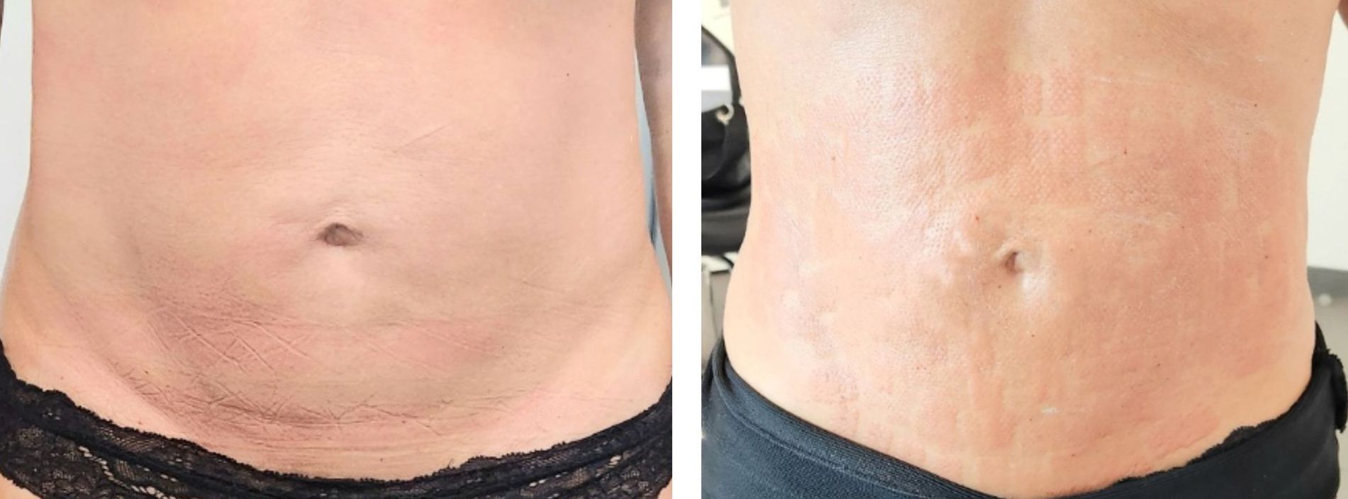 Before and after shots of a person's midsection, showing a change in skin texture after body countoring and body scultping with a Morpheus8 microneedling with radiofrequency procedure performed by the best cosmetic doctor in Miami, Fl, Dr. Barrueta, at the best med spa in Miami, FL, Monaco MedSpa.