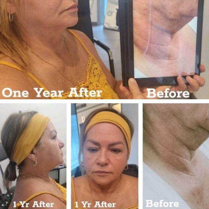 A woman is shown before and after one year.