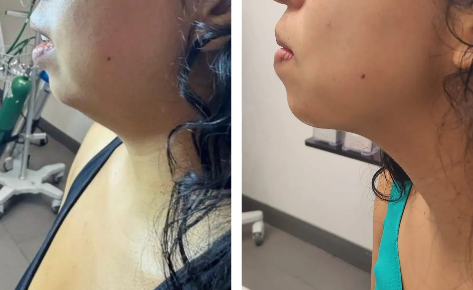 microneedling with radiofrequency, Morpheus8 Lower Face , Morpheus8 Neck Before and After, Miami, FL. microneedling with radiofrequency, Before and After, Monaco Medspa in Midtown Edgewater Miami, FL, Morpheus8 Face, Morpheus8 Neck, Photos of Before and After Morpheus8, Monaco med spa in Midtown Edgewater Miami, FL