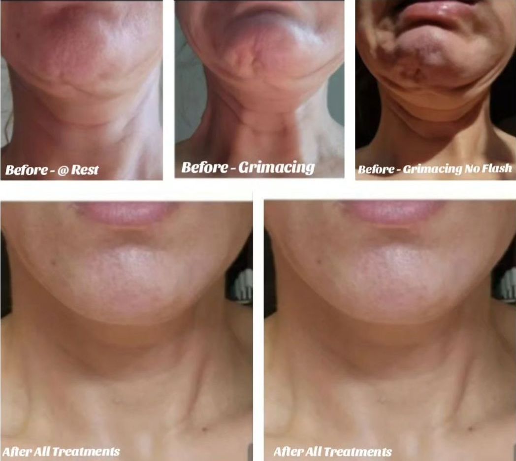 photo of Before and After of a nonsurgical neck lift cosmetic neck treatment at Monaco med spa Midtown Miami, Edgewater Miami, FL, and Morpheus8 Face & Neck Treatments.
Jaw Contouring & Chin Filler.
Biostimulating Neck Fillers x 2 Treatments.
Neck Bands, Nefertiti Jawline, Chin & Marionette Lines (DAO) Botox.
Top Row Left: Before, At Rest.
Top Row Right: Before, Contracting Chin & Neck Muscles.
Bottom Row Right: Before, Contracting Chin & Neck Muscles Under Lighting.
Bottom Row Left: 7 Months After All Treatments. Sculptra. nonsurgical necklift, neck lift, neck restoration treatments