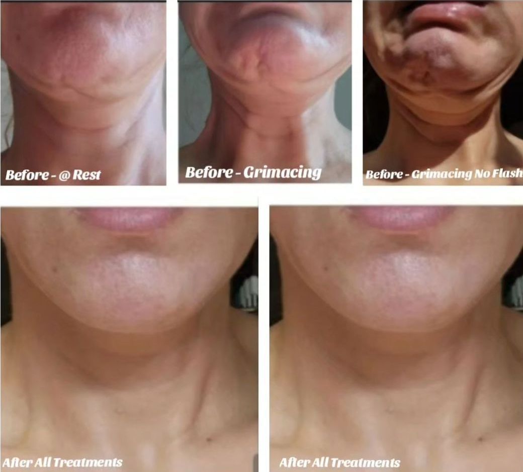 Chin and neck before and after treatment; showing reduced wrinkles and improved skin tone after a Morpheus8 microneedling with radiofrequency procedure performed by the best cosmetic doctor in Miami, Fl, Dr. Barrueta, at the best med spa in Miami, FL, Monaco MedSpa..