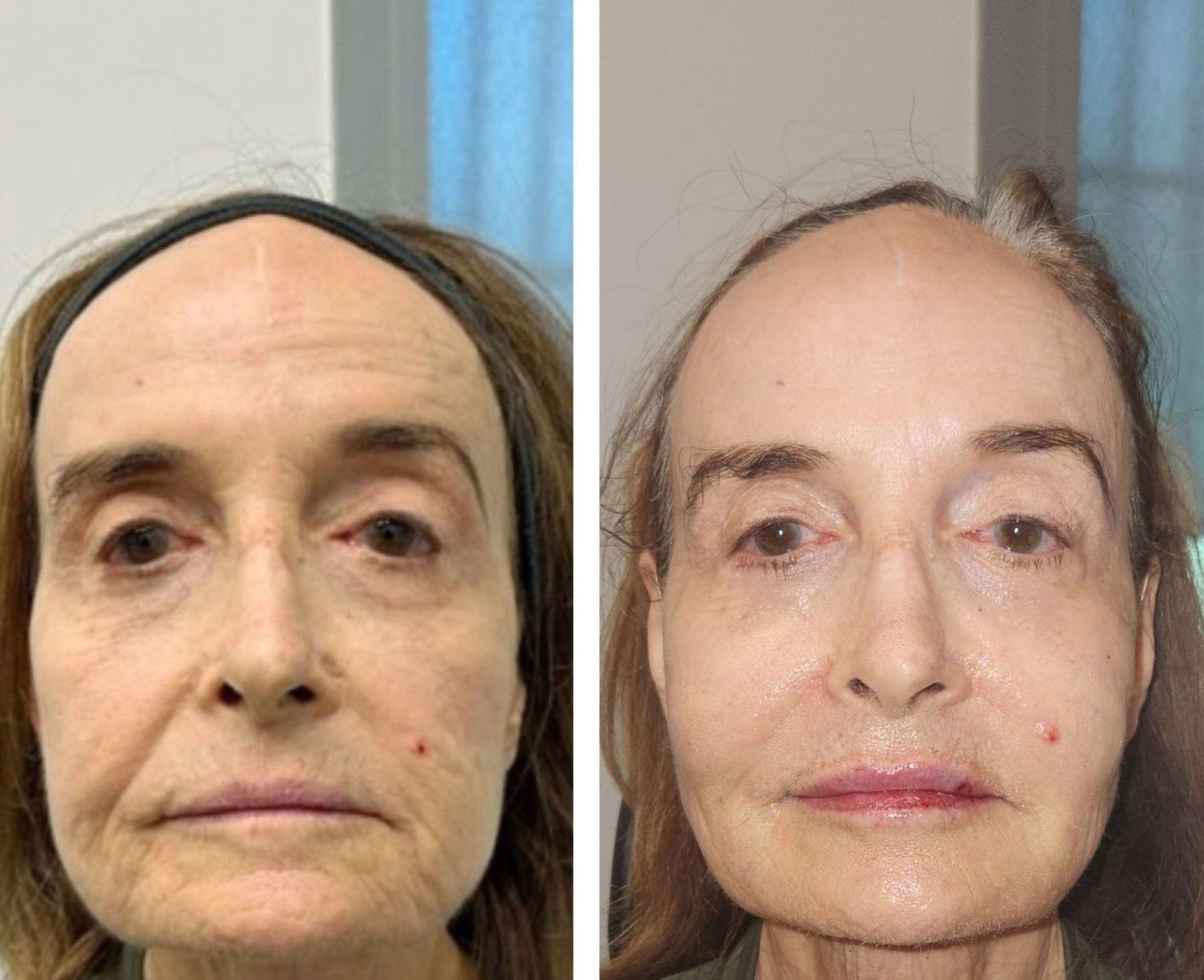 Before and After, Monaco Medspa in Midtown Edgewater Miami, FL, sculptra filler face, lip filler , photo of Before and After Sculptra Filler, Monaco med spa in Midtown Edgewater Miami, FL Monaco med spa in downtown worldcenter edgewater midtown Miami, FL