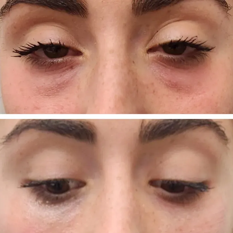 Tear Trough Eye Filler Before & Immediately After, Monaco MedSpa, Miami, FL, edgewater miami, midtown miami, eyelid filler, undereye filler, lower eyelid filler, ha filler, hyaluronic acid filler, juvederm, restylane, belotero, Photo of Before and After tear trough filler Hyaluronic Acid Filler, Monaco med spa in Midtown Edgewater Miami, FL
