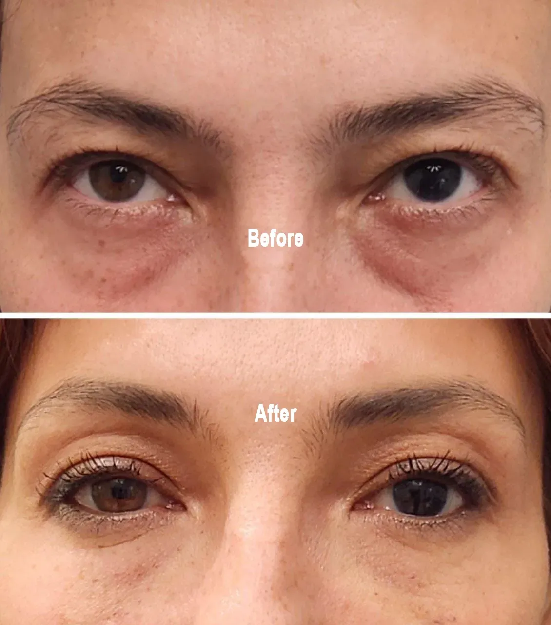 Before and after Morpheus8 for the eyes, Monaco Medspa, medical spa, Miami FL.