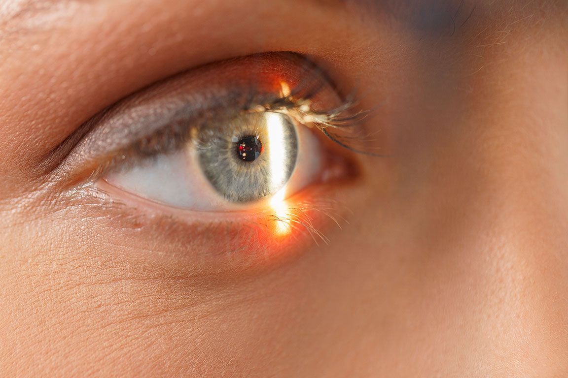 Cirugía Lasik